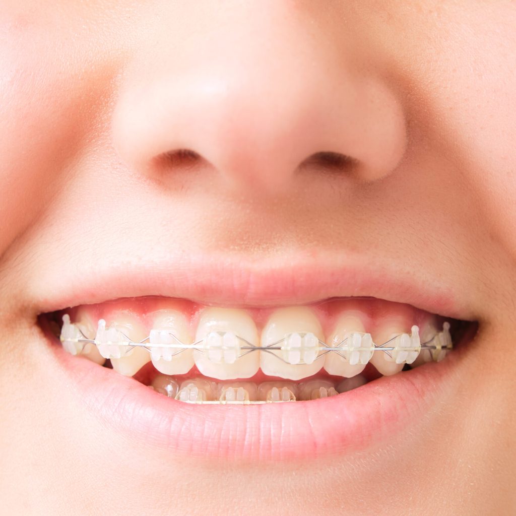 smiling mouth with dental aligner closeup of white teenage girl's mouth smiling with invisible white dental aligner