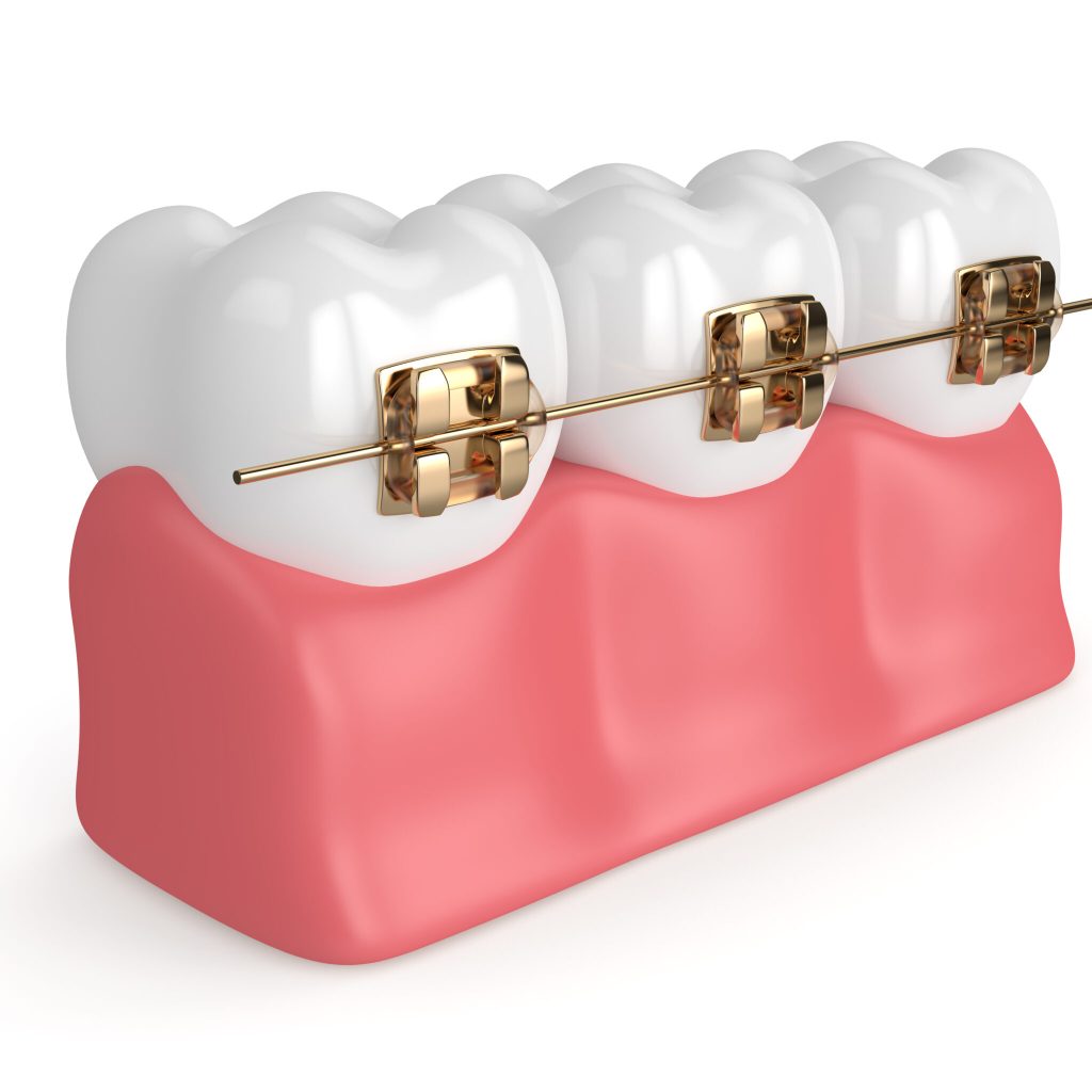 3d render of teeth with golden orthodontic braces 3d render of teeth with golden orthodontic braces isolated over white background