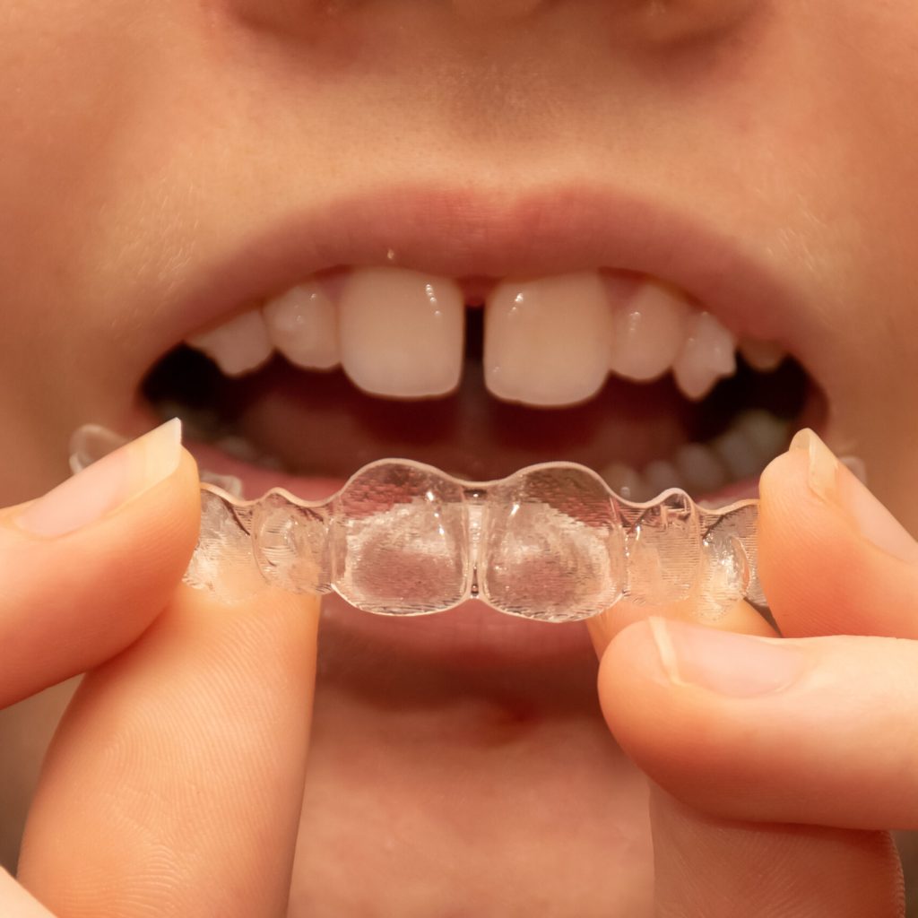 Close up of a girl holding put on invisible braces. Orthodontic dental braces teeth straighteners. Gap between front teeth Davie Removable Braces